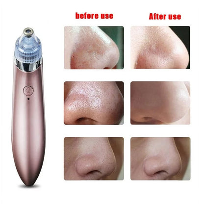 4 in 1 Black Head Removal Machine